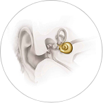 High Frequency Sensorineural Hearing Loss High Frequency Sensorineural Hearing Loss