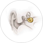 Severe-to-Profound Sensorineural Hearing Loss Severe-to-Profound Sensorineural Hearing Loss